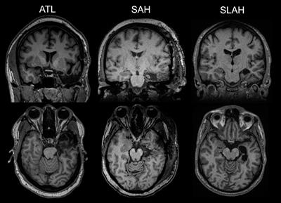 Superior Verbal Memory Outcome After Stereotactic Laser Amygdalohippocampotomy